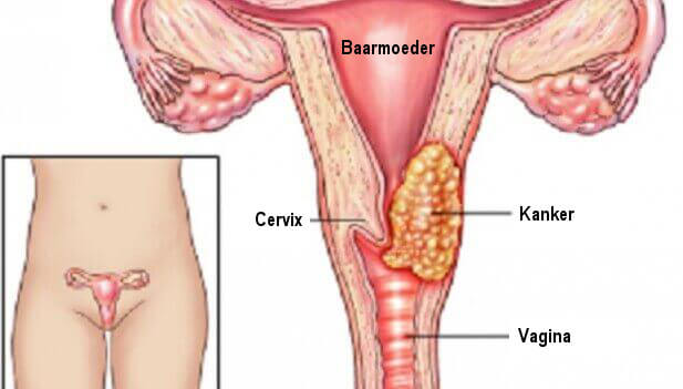 baarmoederhalskanker 1